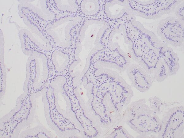 Immunohistochemistry (IHC) : Human stomach stained with anti-H. pylori antibody using peroxidase-conjugate and DAB chromogen. Note intense staining of H. Pylori organisms on the surface of gastric epithelial cells.