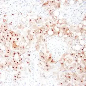 Immunohistochemistry (IHC) : Human liver infected with hepatitis B virus stained with anti-HBcAg antibody using peroxidase-conjugate and DAB chromogen. Note the nuclear staining of infected hepatocytes.