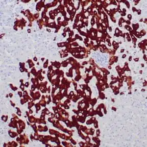 Immunohistochemistry (IHC) : Human liver infected by hepatitis B virus stained with anti-HBsAg antibody using peroxidase-conjugate and DAB chromogen. Note the cytoplasmic staining of infected hepatocytes.