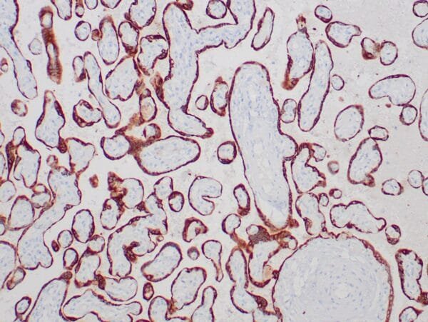 Immunohistochemistry (IHC) : Formalin-fixed, paraffin-embedded human placenta stained with anti-HCG-beta antibody using peroxidase-conjugate and DAB chromogen. Note the cytoplasmic staining of trophoblasts