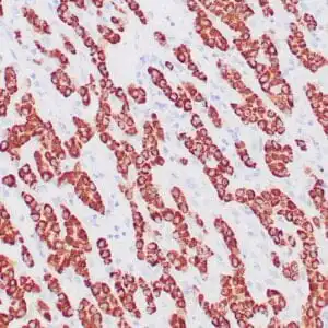 Immunohistochemistry (IHC) : Human liver stained with anti-HepPar-1 antibody using peroxidase-conjugate and DAB chromogen. Note the cytoplasmic staining of hepatocytes.