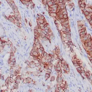 Immunohistochemistry (IHC) : Human breast infiltrating ductal carcinoma stained with anti-Her-2/neu antibody using peroxidase-conjugate and DAB chromogen. Note the strong membrane staining (3+) of carcinoma cells.