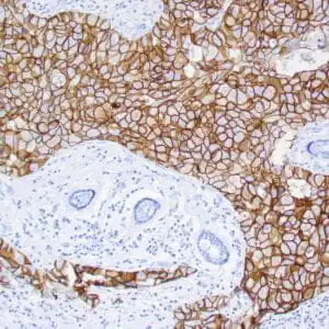 Immunohistochemistry (IHC) : Human breast infiltrating ductal carcinoma stained with anti-Her-2/neu antibody using peroxidase-conjugate and DAB chromogen. Note the strong membrane staining (3+) of carcinoma cells.