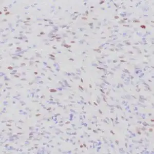 Immunohistochemistry (IHC) : Human Kaposi sarcoma  stained with anti-HHV-8 antibody using peroxidase-conjugate and DAB chromogen. Note the nuclear staining of tumor cells.
