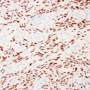 Immunohistochemistry (IHC) : Human Kaposi’s sarcoma stained with anti-HHV-8 antibody using peroxidase-conjugate and DAB chromogen. Note nuclear staining of sarcoma cells.