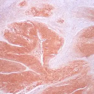 Immunohistochemistry (IHC) : Human cervical carcinoma stained with anti-HPV antibody using peroxidase-conjugate and DAB chromogen. Note the nuclear and cytoplasmic staining of carcinoma cells.