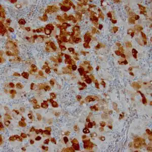 Immunohistochemistry (IHC) : Formalin-fixed, paraffin-embedded human hepatocellular carcinoma stained with anti-HSP70 using peroxidase-conjugate and DAB chromogen. Note cell cytoplasmic staining of tumor cells