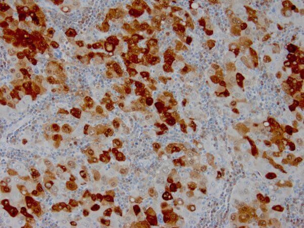 Immunohistochemistry (IHC) : Formalin-fixed, paraffin-embedded human hepatocellular carcinoma stained with anti-HSP70 using peroxidase-conjugate and DAB chromogen. Note cell cytoplasmic staining of tumor cells