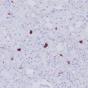 Immunohistochemistry (IHC) : Formalin-fixed, paraffin-embedded human lung with HSV infection stained with anti-HSV II antibody using peroxidase-conjugate and AEC chromogen. Note cytoplasmic/nuclear staining of infected hepatocytes