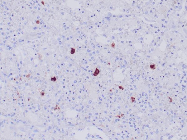 Immunohistochemistry (IHC) : Formalin-fixed, paraffin-embedded human lung with HSV infection stained with anti-HSV II antibody using peroxidase-conjugate and AEC chromogen. Note cytoplasmic/nuclear staining of infected hepatocytes