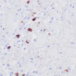 Immunohistochemistry (IHC) : Human skin with HSV infection stained with anti-HSV I antibody using  peroxidase-conjugate and DAB chromogen. Note cytoplasmic/nuclear staining of infected hepatocytes.