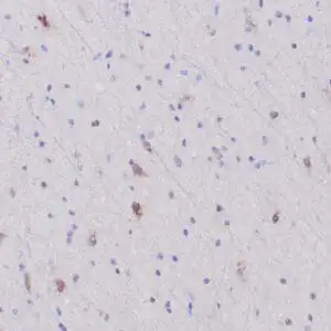Immunohistochemistry (IHC) : Formalin-fixed, paraffin-embedded human glioma stained with anti-IHD1 antibody using peroxidase-conjugate and DAB chromogen. Note nuclear and cytoplasmic staining of infiltrating glioma cells whereas normal glial cells are negative