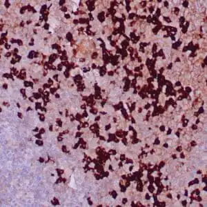 Immunohistochemistry (IHC) : Formalin-fixed, paraffin-embedded human tonsil stained with anti-IgA antibody using peroxidase-conjugate and DAB chromogen. Note cytoplasmic staining of plasma cells