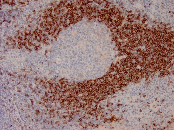 Immunohistochemistry (IHC) : Formalin-fixed, paraffin-embedded human lymph node stained with anti-IgD antibody using peroxidase-conjugate and DAB chromogen. Note cytoplasmic staining of mantle B cells