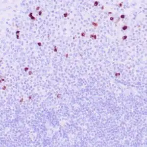 Immunohistochemistry (IHC) : Human salivary gland stained with anti-IgG4 antibody using peroxidase-conjugate and DAB chromogen. Note the cytoplasmic staining of plasma cells.