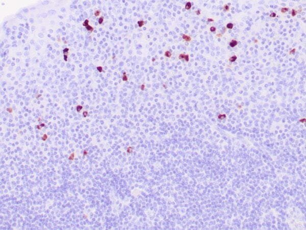 Immunohistochemistry (IHC) : Human salivary gland stained with anti-IgG4 antibody using peroxidase-conjugate and DAB chromogen. Note the cytoplasmic staining of plasma cells.