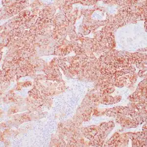 Immunohistochemistry (IHC) : Human pancreatic ductal adenocarcinoma stained with anti-IMP3 antibody  using peroxidase-conjugate and DAB chromogen. Note cytoplasmic staining of tumor cells.