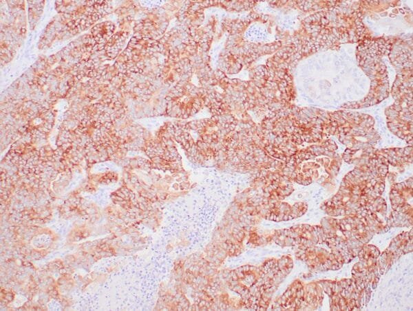 Immunohistochemistry (IHC) : Human pancreatic ductal adenocarcinoma stained with anti-IMP3 antibody  using peroxidase-conjugate and DAB chromogen. Note cytoplasmic staining of tumor cells.