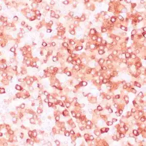 Immunohistochemistry (IHC) : Human adrenal cortical tumor stained with anti-inhibin a antibody using peroxidase-conjugate and DAB chromogen. Note the cytoplasmic staining of tumor cells.