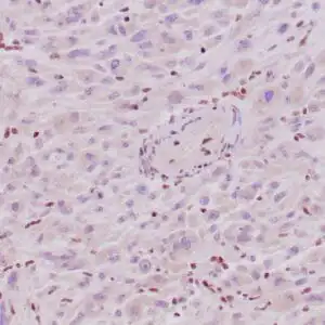 Immunohistochemistry (IHC) : Human epithelioid sarcoma stained with anti-INI-1 antibody using peroxidase-conjugate and DAB. Note the absence of nuclear staining of tumor cells, whereas the background cells are positive.