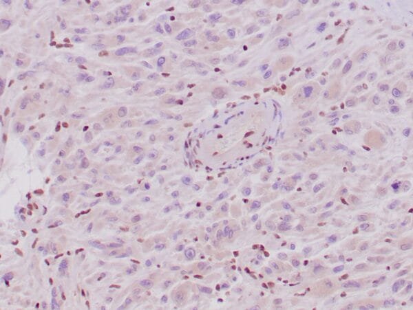 Immunohistochemistry (IHC) : Human epithelioid sarcoma stained with anti-INI-1 antibody using peroxidase-conjugate and DAB. Note the absence of nuclear staining of tumor cells, whereas the background cells are positive.