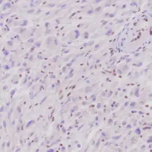 Immunohistochemistry (IHC) : Human epithelioid sarcoma stained with anti-INI-1 antibody using peroxidase-conjugate and DAB. Note the absence of nuclear staining of stromal/endothelial cells and absence of staining in tumor cells, whereas the background cells with nuclear staining.