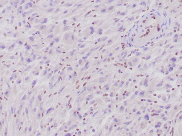 Immunohistochemistry (IHC) : Human epithelioid sarcoma stained with anti-INI-1 antibody using peroxidase-conjugate and DAB. Note the absence of nuclear staining of stromal/endothelial cells and absence of staining in tumor cells, whereas the background cells with nuclear staining.