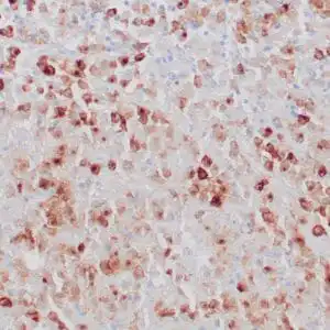 Immunohistochemistry (IHC) : Formalin-fixed, paraffin-embedded human Langerhans cell histiocytosis stained with anti-langerin antibody using peroxidase-conjugate and DAB chromogen. Note cytoplasmic staining of tumor cells