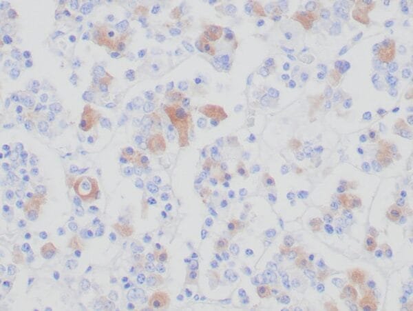 Immunohistochemistry (IHC) : Formalin-fixed, paraffin-embedded human pituitary stained with anti-FSH antibody using peroxidase-conjugate and DAB chromogen. Note the cytoplasmic staining of glandular cells