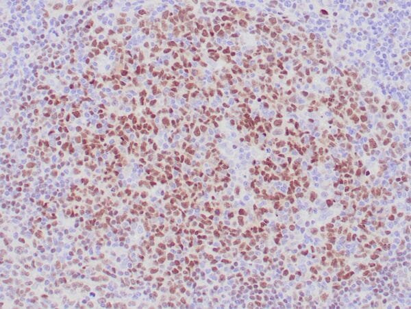 Immunohistochemistry (IHC) : Formalin-fixed, paraffin-embedded human lymph node stained with anti-LMO2 antibody using peroxidase-conjugate and AEC chromogen. Note nuclear staining of germinal center cells