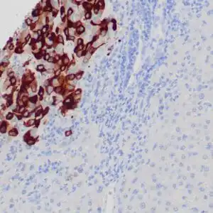 Immunohistochemistry (IHC) : Formalin-fixed, paraffin-embedded human liver metastatic breast carcinoma stained with anti-mammaglobin antibody using peroxidase-conjugate and DAB chromogen. Note cytoplasmic staining of tumor glands.