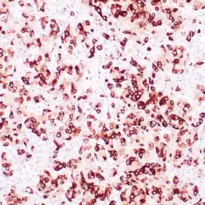Immunohistochemistry (IHC) : Human breast carcinoma stained with anti-Mammaglobin antibody using peroxidase-conjugate and DAB chromogen. Note cytoplasmic staining of tumor glands.
