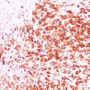 Immunohistochemistry (IHC) : Human breast carcinoma stained with anti-Mammaglobin antibody using peroxidase-conjugate and DAB chromogen. Note cytoplasmic staining of tumor cells..