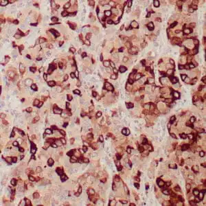 Immunohistochemistry (IHC) : Human breast carcinoma stained with anti-Mammaglobin antibody using peroxidase-conjugate and DAB chromogen. Note cytoplasmic staining of tumor glands.