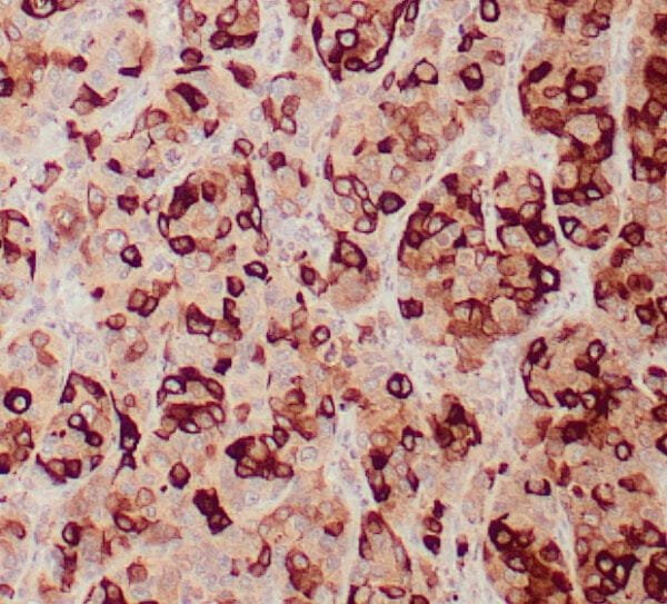 Immunohistochemistry (IHC) : Human breast carcinoma stained with anti-Mammaglobin antibody using peroxidase-conjugate and DAB chromogen. Note cytoplasmic staining of tumor glands.