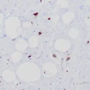 Immunohistochemistry (IHC) : Formalin-Fixed, paraffin-embedded human atypical lipomatous tumor stained with anti-MDM2 antibody using peroxidase-conjugate and DAB chromogen. Note the nuclear staining of tumor cells