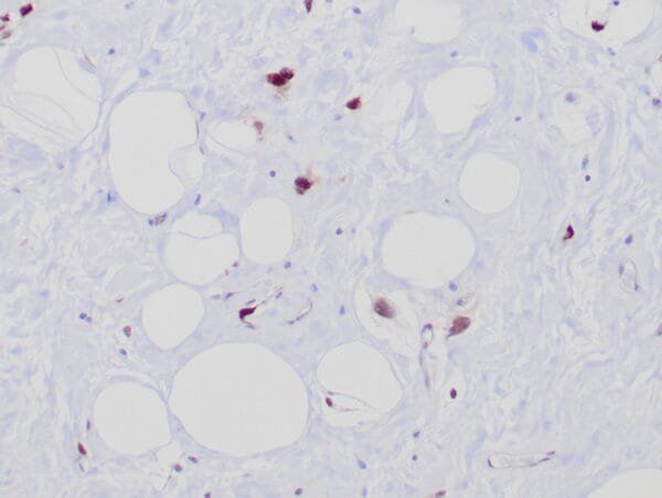 Immunohistochemistry (IHC) : Formalin-Fixed, paraffin-embedded human atypical lipomatous tumor stained with anti-MDM2 antibody using peroxidase-conjugate and DAB chromogen. Note the nuclear staining of tumor cells