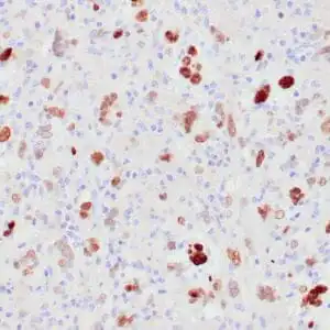 Immunohistochemistry (IHC) : Human atypical lipomatous tumor stained with anti-MDM2 antibody using peroxidase-conjugate and DAB chromogen. Note the nuclear staining of tumor cells.