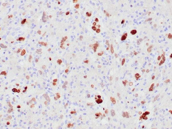 Immunohistochemistry (IHC) : Human atypical lipomatous tumor stained with anti-MDM2 antibody using peroxidase-conjugate and DAB chromogen. Note the nuclear staining of tumor cells.