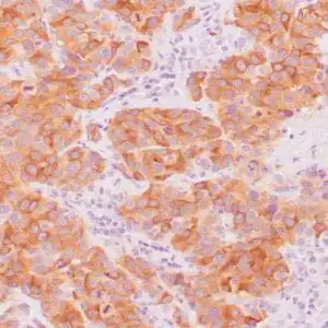 Immunohistochemistry (IHC) : Human melanoma stained with anti-Melan-A antibody using peroxidase-conjugate and DAB chromogen. Note the cytoplasmic staining of melanoma cells.