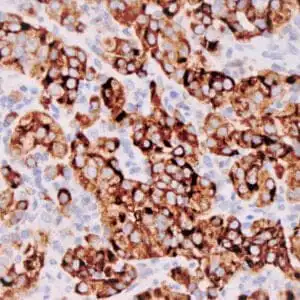 Immunohistochemistry (IHC) : Human melanoma stained with anti-HMB-45 antibody using peroxidase-conjugate and DAB chromogen. Note the cytoplasmic staining of melanoma cells.