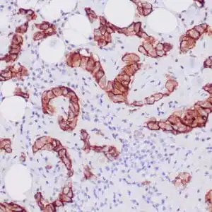 Immunohistochemistry (IHC) : Human mesothelioma stained with anti-Mesothelin antibody using peroxidase-conjugate and DAB chromogen. Note membranous staining of tumor cells.