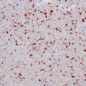 Immunohistochemistry (IHC) : Human colon carcinoma stained with MGMT antibody using peroxidase-conjugate and DAB chromogen. Note the nuclear staining of tumor cells.