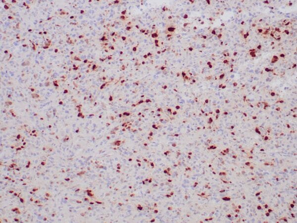 Immunohistochemistry (IHC) : Human colon carcinoma stained with MGMT antibody using peroxidase-conjugate and DAB chromogen. Note the nuclear staining of tumor cells.