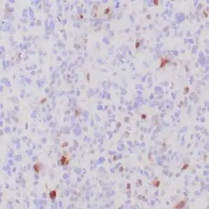 Immunohistochemistry (IHC) : Formalin-fixed, paraffin-embedded human glioma stained with MGMT antibody using peroxidase-conjugate and DAB chromogen. Note the nuclear staining of tumor cells