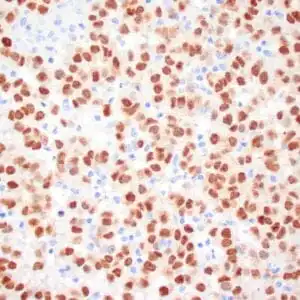 Immunohistochemistry (IHC) : Human melanoma stained with MiTF C5/D5 antibodies using peroxidase-conjugate and DAB chromogen. Note nuclear staining of tumor cells.