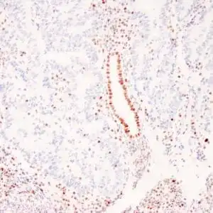 Immunohistochemistry (IHC) : Human colon adenocarcinoma with Lynch syndrome stained with anti-MLH-1 antibody using peroxidase-conjugate and DAB chromogen. Note absence of nuclear staining of tumor cells whereas the background non tumor cells are positive.