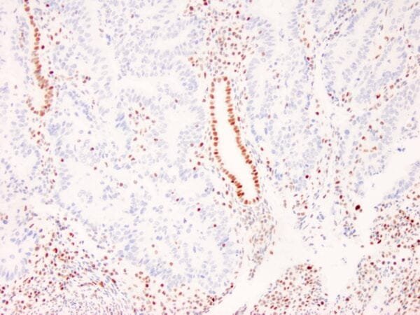 Immunohistochemistry (IHC) : Human colon adenocarcinoma with Lynch syndrome stained with anti-MLH-1 antibody using peroxidase-conjugate and DAB chromogen. Note absence of nuclear staining of tumor cells whereas the background non tumor cells are positive.