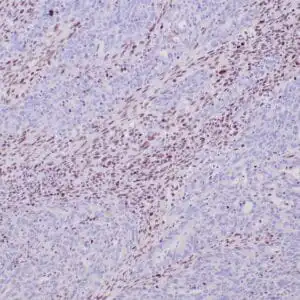 Immunohistochemistry (IHC) : Human colon adenocarcinoma with Lynch syndrome stained with anti-MLH-1 antibody using peroxidase-conjugate and DAB chromogen. Note absence of nuclear staining of tumor cells whereas the background non tumor cells are positive.