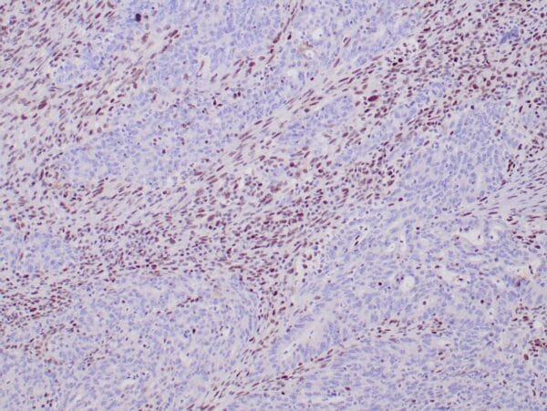 Immunohistochemistry (IHC) : Human colon adenocarcinoma with Lynch syndrome stained with anti-MLH-1 antibody using peroxidase-conjugate and DAB chromogen. Note absence of nuclear staining of tumor cells whereas the background non tumor cells are positive.